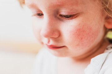food allergy in a young child on the cheeks - obrazy, fototapety, plakaty