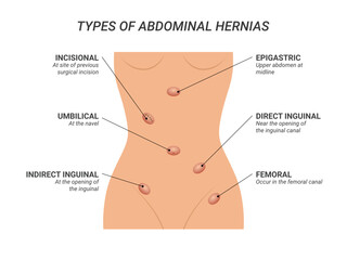 Types of abdominal hernias illustration on isolated background - obrazy, fototapety, plakaty