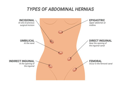 Abdominal Hernia Images &#8211; Browse 1,297 Stock Photos, Vectors, and ...