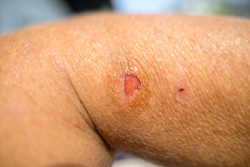 Close up detail of trauma on a persons arm