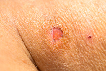 Detail of a healing wound on a persons arm