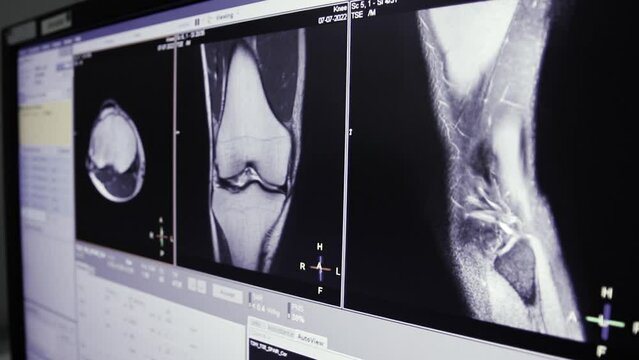 MRI Knee joint or magnetic resonance imaging of the knee for diagnosis trauma