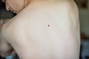 Checking benign moles. Close up detail of the bare skin on a man back with scattered moles and freckles. Sun effect on skin. Pigmentation. Birthmarks on skin