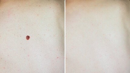 image of mole on man skin before after laser treatment