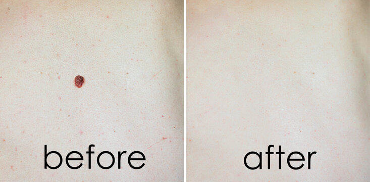 image of mole on man skin before after laser treatment