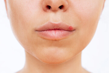 Herpes on the lip. Blisters caused by virus on the mouth of a young woman isolated on a white background. Itching and redness on the girl's face