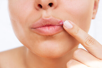 Herpes on the lip. Young woman smears the blisters caused by virus on the mouth with ointment isolated on a white background. Itching and redness on the girl's face. Treatment of herpes - obrazy, fototapety, plakaty