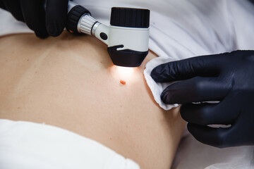 A cosmetologist doctor in black gloves examines the patient's mole using a dermatoscope. Close-up - obrazy, fototapety, plakaty