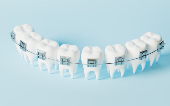 Teeth brace in the blue background, 3d rendering.
