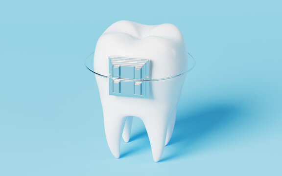Tooth brace in the blue background, 3d rendering.
