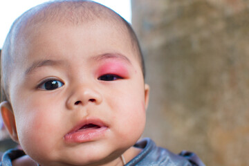 little baby infection at the eyelid caused by being bitten by insects causing swelling and redness and heat and itching