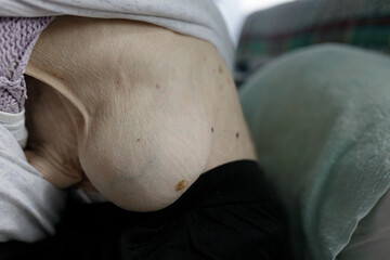Fototapeta premium An old woman has a huge tumor growing on the side of her ribs.
