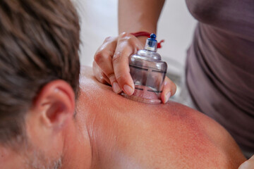 Cup massage close up. Banks for massage on male back. Alternative medicine. Massage with vacuum...