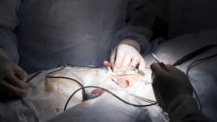 Team surgeon at work in operating room. Action. Close up of penis enlargement surgery to increase...