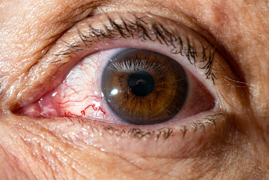 Close-up of female eye with red inflamed and dilated capillaries. Blood vessel.