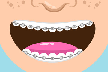 Tooth with braces vector illustration