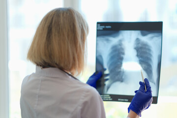 Doctor pulmonologist examining x-ray photograph of lungs - obrazy, fototapety, plakaty