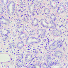 Camera photo of breast mass, showing tubular variant of fibrosarcoma, magnification 400x, photograph through a microscope
