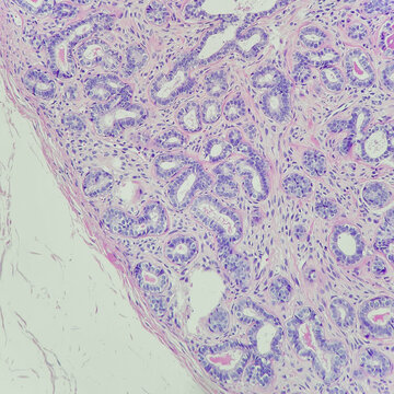 Camera photo of fibroadenoma showing well defined border with fibrous encapsulation, magnification 200x, photograph through a microscope