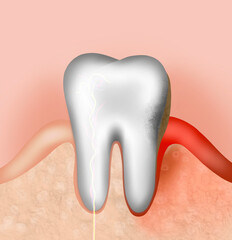 Infected gum and tooth, illustration. Periodontal disease