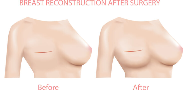 Women Breast reconstruction Before and after surgery, Front view 3D Realistic design Vector.