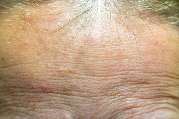 Fototapeta premium The forehead of a woman with problematic skin