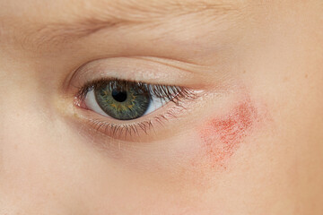Abrasion on the face of a girl's child. Wound under the eye close-up. The concept of treatment of...