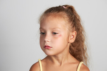 Abrasion on the face of a girl's child. Wound under the eye close-up. The concept of treatment of...