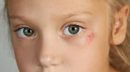 Abrasion on the face of a girl's child. Wound under the eye close-up. The concept of treatment of childhood trauma