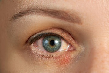Peeling and swelling on the eyelid of the human eye.