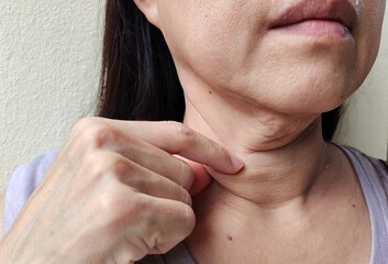 portrait showing the fingers squeezing the flabbiness adipose sagging skin under the neck, Dullness and mole, problem wrinkled and flabby skin on the body of the woman, concept health care. - obrazy, fototapety, plakaty