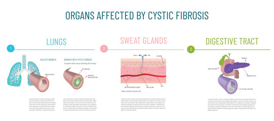 Infographics of the main organs affected by cystic fibrosis