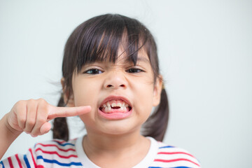 little Asian girl showing her broken milk teeth.