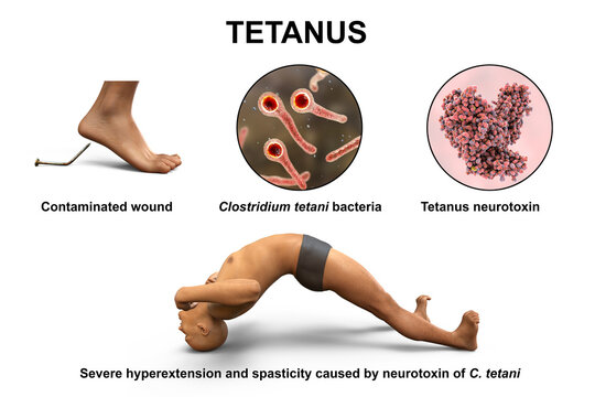 Tetanus disease, opisthotonus in a man suffering from tetanus