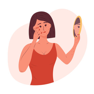 Sad Woman With A Rash On Her Face And Hands Looks In The Mirror. Monkeypox Virus , Allergic Itch, Skin Inflammation, Redness, Irritation, Psoriasis, Atopic Dermatitis, Eczema.