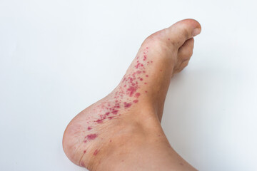 Infectious disease of the legs. Foot fungus and allergic rash