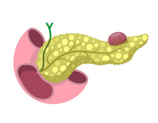 Pancreatic pseudocyst concept. Disease diagnostic illustration for education material, brochure, website, medical portal, atlas, textbook, presentation, medicine packaging etc.. 