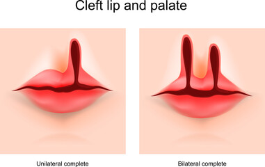 Cleft lip and cleft palate - obrazy, fototapety, plakaty