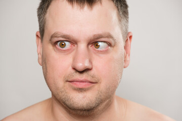 Fototapeta premium A man with strabismus squints his eyes on a white background.
