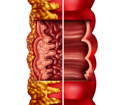 Crohn's Disease and Crohn syndrome illness or crohns illness and healthy colon as a medical concept with inflammation symptoms causing obstruction