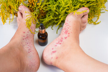 Treatment of infectious foot disease with oils and medicinal herbs. Foot fungus and allergic rash