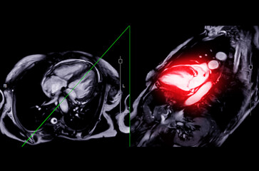 MRI heart or Cardiac MRI .