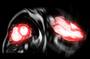 MRI heart or Cardiac MRI .