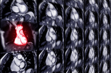 MRI heart or Cardiac MRI .