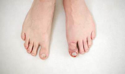 Obraz na płótnie Canvas Fractured toe. Broken big toe