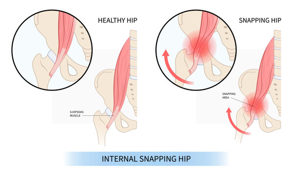 Hip Joint Tear And Broken Coxa Saltans Flexor Stretch Pain Rectus Bursae Intra Groin Strain Iliacus Psoas Torn Major Band Thigh Tract Labral Tensor Femur Tendon Injury Muscle Greater Trauma Labrum