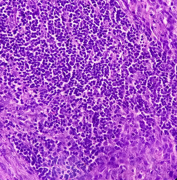 Infected Pre Auricular Lymph Node(biopsy): Warthin Tumor, Show Lymph Node Tissue. Also Known As Papillary Cystadenoma Lymphomatosum, Is A Benign Cystic Tumor.