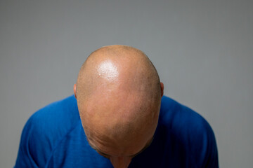 a bald head. alopecia areata. photo from above.