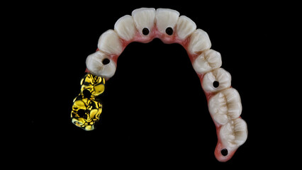 unusual dental prosthesis of the upper jaw made of ceramic and titanium with two gold-plated teeth, top view on a black background © Dental Pro Content