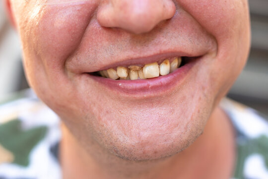 Yellow crooked teeth of a smoker, close-up